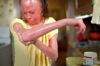 Hunter Steinitz, 15, applies moisturizing lotion to her arm at her house in Brighton Heights.
